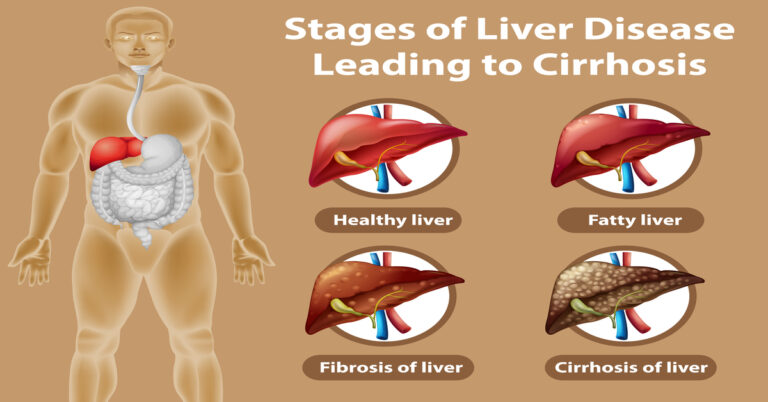 Stages of liver disease leading to Cirrhosis