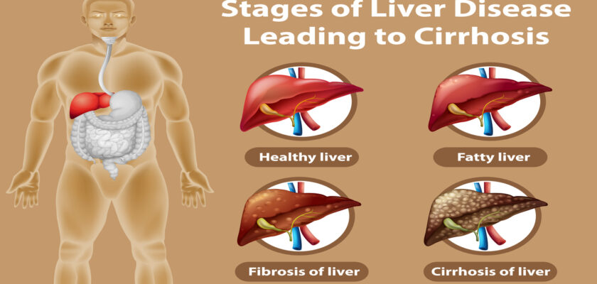 Stages of liver disease leading to Cirrhosis