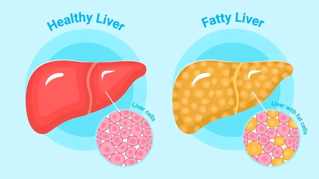 What is Fatty Liver?
